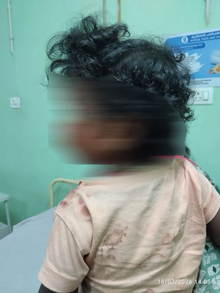 ಅಂಗಳದಲ್ಲಿ ಆಟವಾಡುತ್ತಿದ್ದ ಮಗುವಿನ ಮೇಲೆ ಬೀದಿ ನಾಯಿ ದಾಳಿ: ಮುಖಕ್ಕೆ ಗಂಭೀರ ಗಾಯ